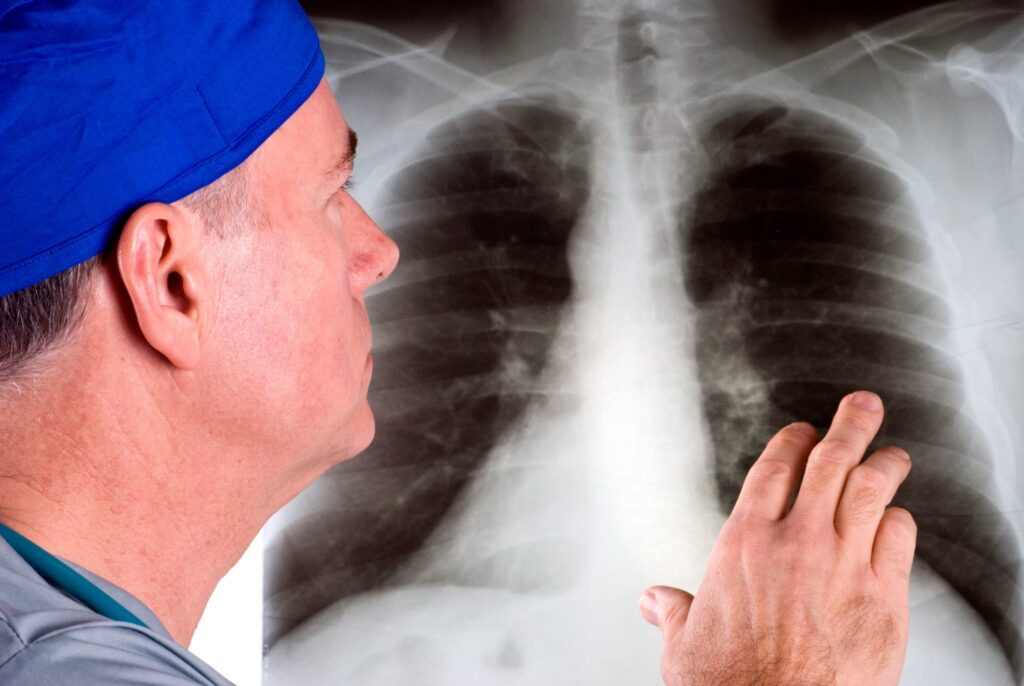 профессиональное лечение онкологии дыхательных путей 